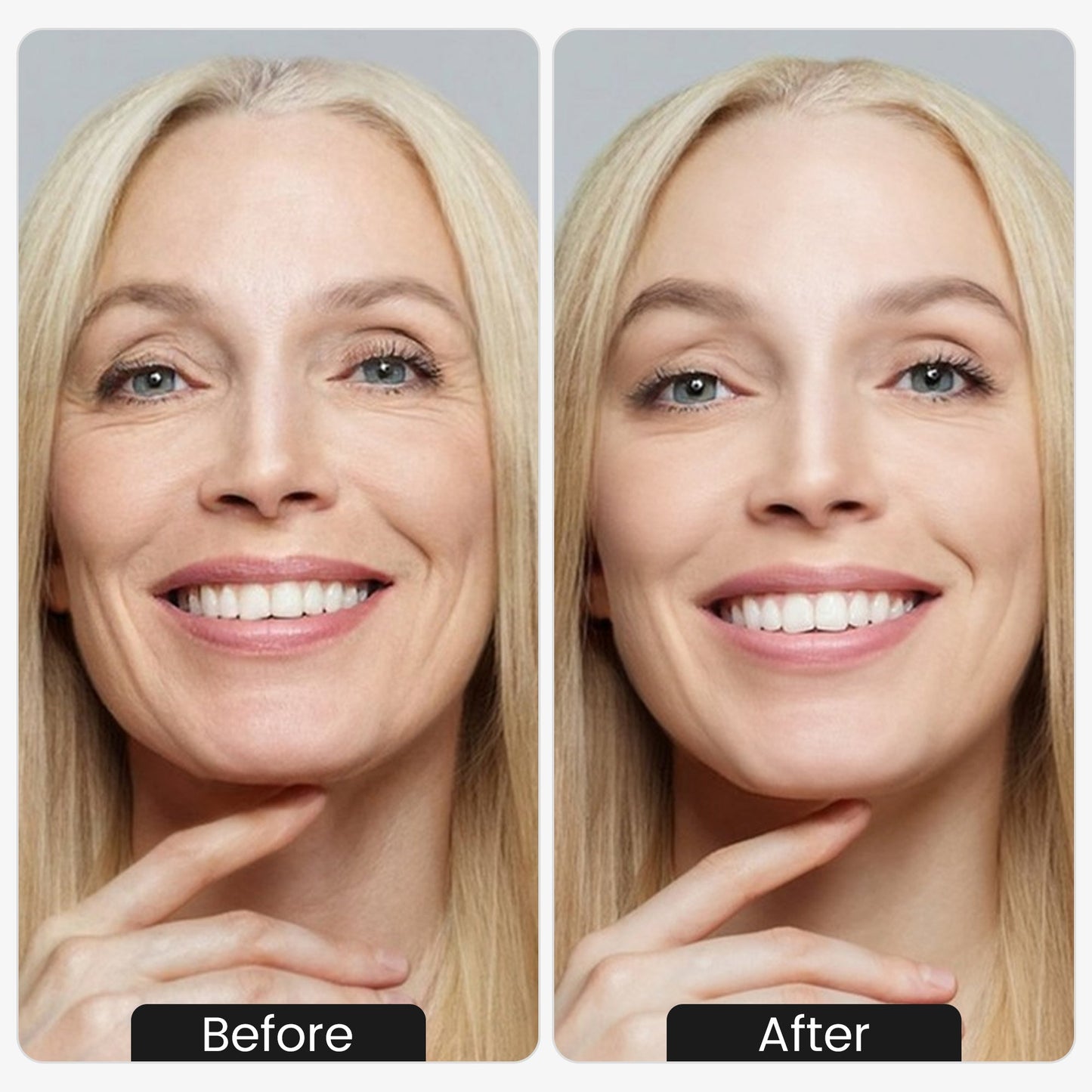 LiftPro Contour - Antes y despues resultado lifting facial mandibula